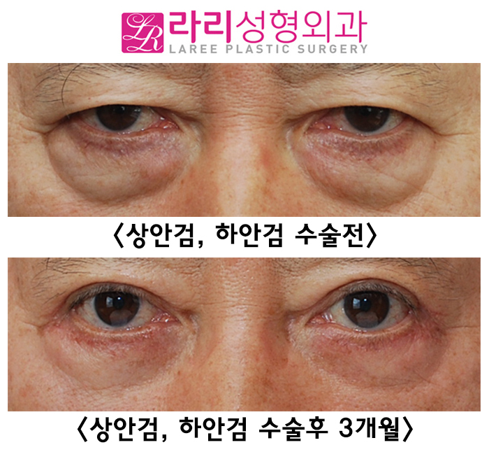 [Lari Plastic Surgery] Lower blepharoplasty including entropion correction, the most common cause of iatrogenic ectropion image 6