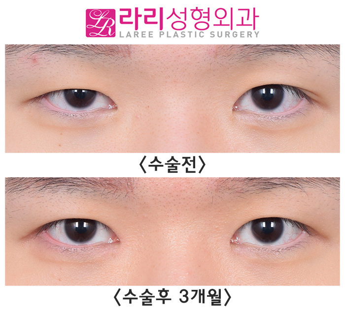 [Rari Plastic Surgery] Pre- and Post-Operation Photos of Uneven Double-Eyelid Correction and Double-Eyelid Removal on Different Sides image 6