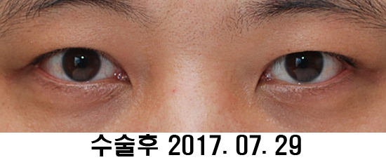 Before and After: Sharper Male Eye Correction (feat. Video) image 11