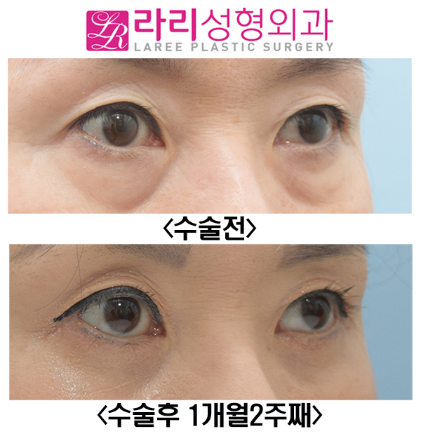 [Lari Plastic Surgery] Short-Term Before-and-After Photos of Lower Blepharoplasty: How to Avoid Ectropion image 3