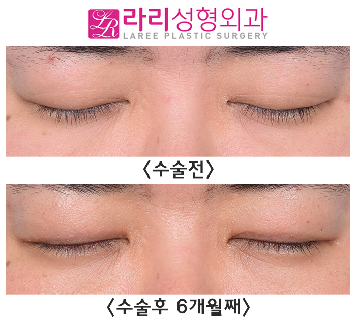 [Rari Plastic Surgery] Difficulty Opening the Eyes, Severe Asymmetry, and Multiple Eyelid Creases: Solved with Crease Removal Surgery! image 4