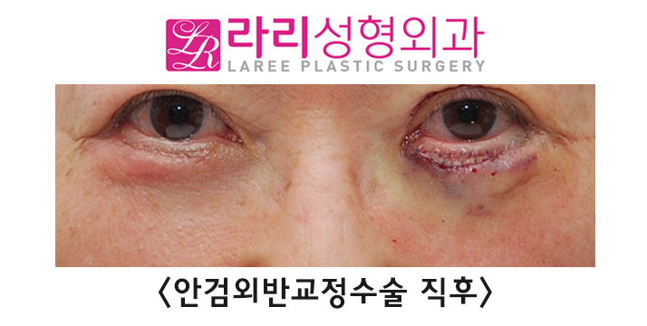 [라리성형외과] 노화로 나타나는 노인성 안검외반의 교정 관련 이미지 5
