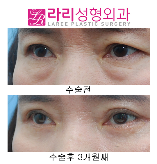 (Middle-aged) Upper Eyelid Surgery and Lower Eyelid Surgery at the Same Time image 4