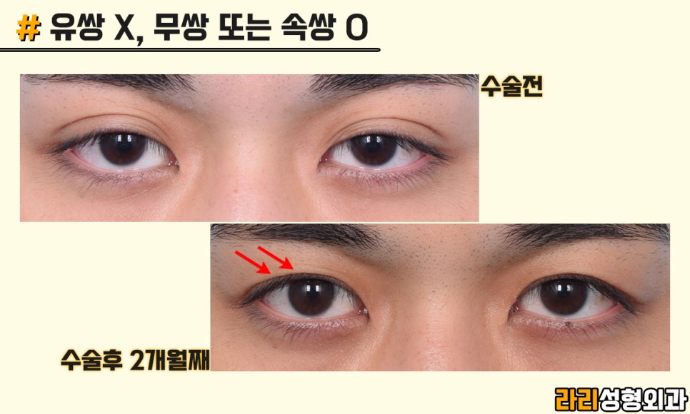 [Lari Plastic Surgery] Men’s Eye Surgery, Trends and Desired Look - Monolid & Hidden Double Eyelid image 3