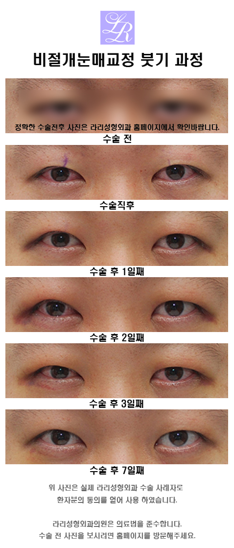 Non-Incisional Eye Correction Swelling, a Review Showing Its Effect image 2