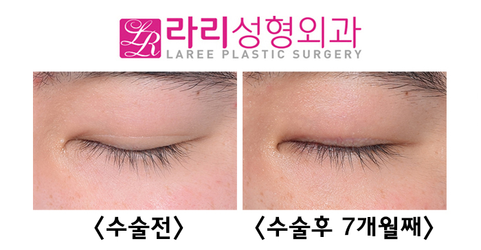 [라리성형외과] 자연쌍꺼풀 비대칭 교정 쌍꺼풀없애기 수술 전후 사진 관련 이미지 5