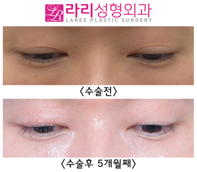 [라리성형외과] 나는 쌍꺼풀없애는수술을 하면 어떻게 될까? 관련 이미지 4