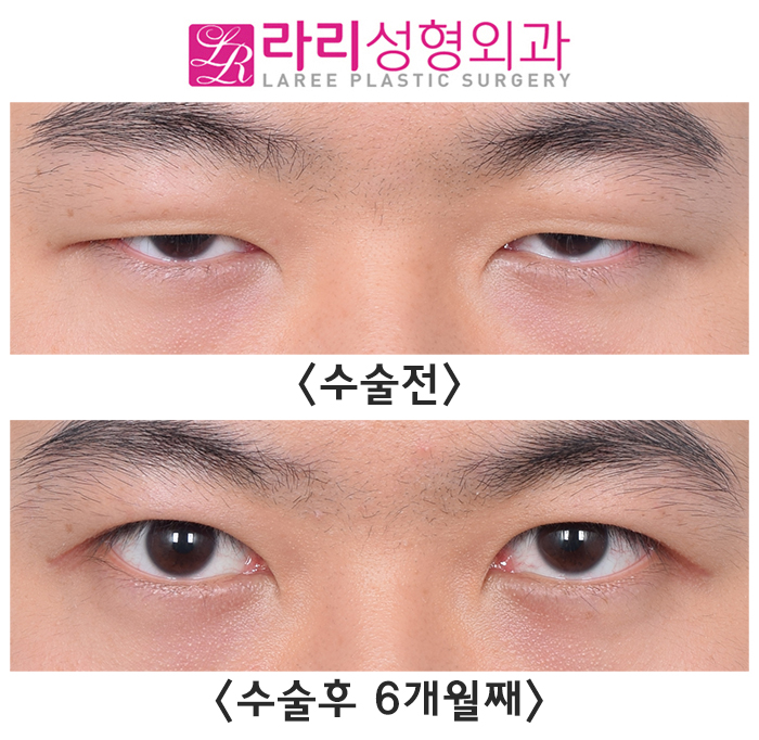[Lari Plastic Surgery] Before-and-After Comparison Photos of Incisional Eye Correction Surgery That Restores Vision — Not from an Ophthalmology Clinic, but from a Plastic Surgery Clinic image 3