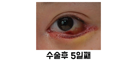 속눈썹 찌름 - 안검내반 교정 최소절개 흉터에 대해 관련 이미지 4