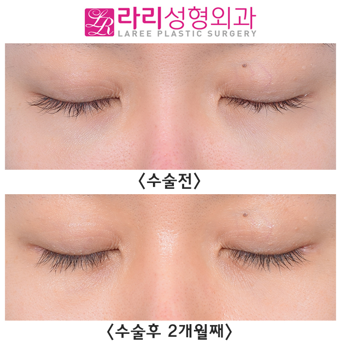 [라리성형외과] 다각도에서 바라보는 비대칭 뒤트임수술 관련 이미지 6