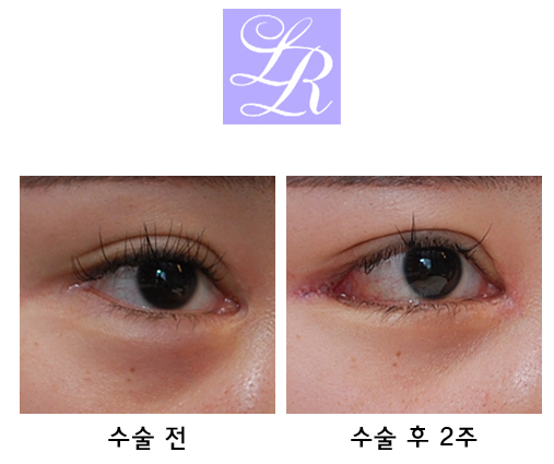 Can medial canthoplasty revision, lateral canthoplasty revision, and under-eye fat repositioning be done at the same time? image 3