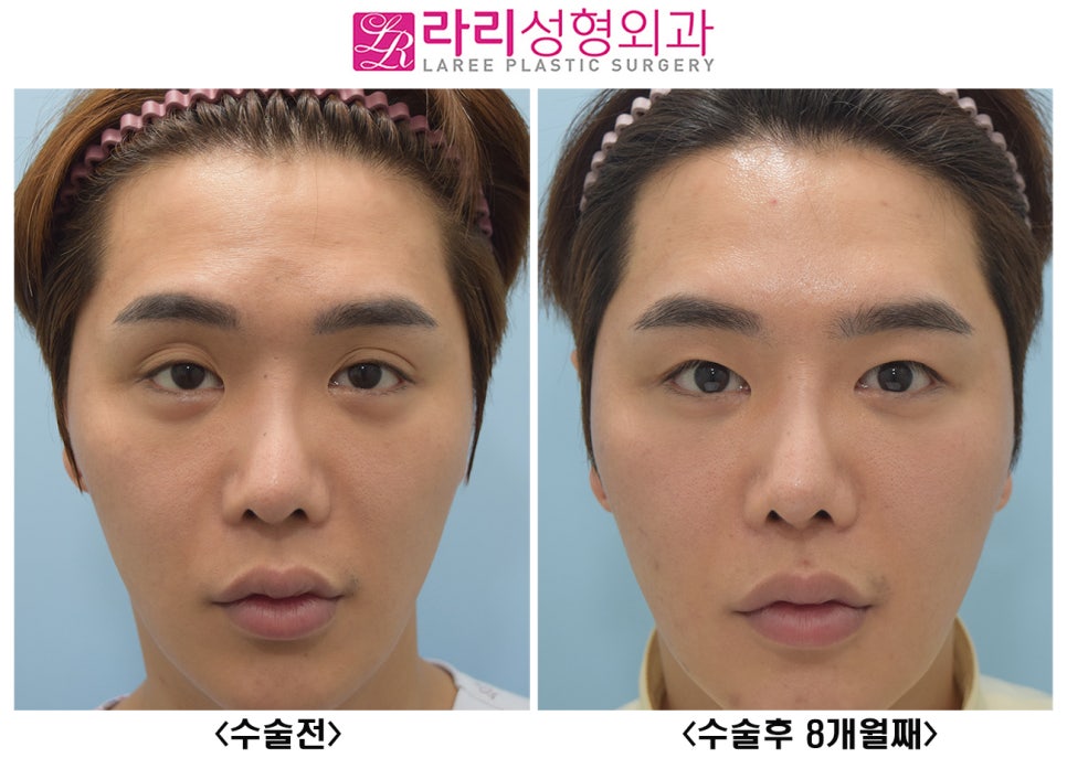 [라리성형외과] 여러겹 두꺼운 자연 쌍꺼풀 무쌍으로 풀기, 없애는 수술 관련 이미지 2