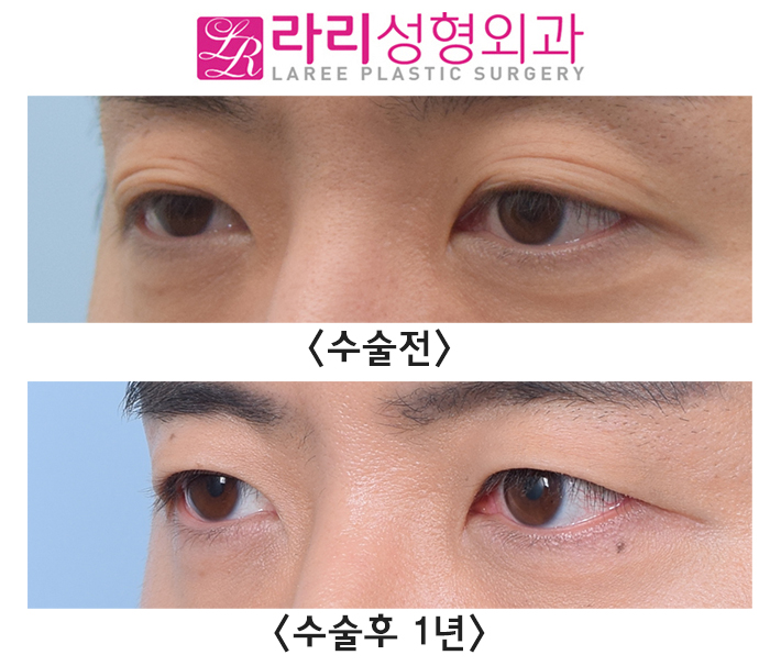 [Rari Plastic Surgery] Natural Double Eyelid Multiple Folds, Removing Them to Create a Monolid: Before and After Surgery After 1 Year image 3