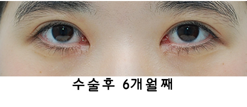 [라리성형외과] 절개쌍수 눈매교정 그리고 앞트임 관련 이미지 2