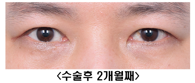 [라리성형외과] 쌍꺼풀없애기 수술 후 짝짝이, 괜찮아질까? 관련 이미지 4