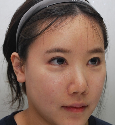 눈꼬리내리기, 뒤트임재수술, 눈밑지방재배치          얼굴인식 바꾸기 관련 이미지 6