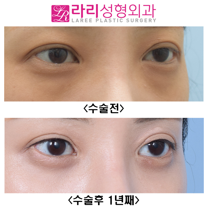[Lari Plastic Surgery] Not a Lower Eyelid Fat Repositioning Surgery That Quickly Comes Back, but a Long-Lasting One image 2