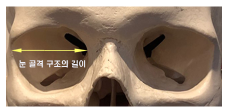 꼬막눈 쌍수 - 짧은눈 왕눈이 수술 관련 이미지 6