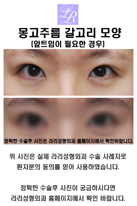 몽고주름제거하는 앞트임 - 갈고리 모양 교정 관련 이미지 1