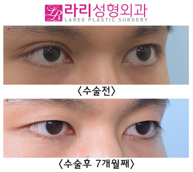 [라리성형외과] 자연쌍꺼풀 ? 쌍수쌍꺼풀 ? 쌍꺼풀없애는수술로 다른 양쪽을 같게 만들어요. 관련 이미지 3