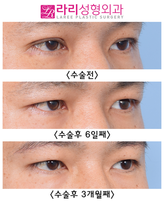 [라리성형외과] 절개 눈매교정 후 급속교정, 6개월 기다리지 않고 일주일 만에 쌍꺼풀없애기 관련 이미지 5