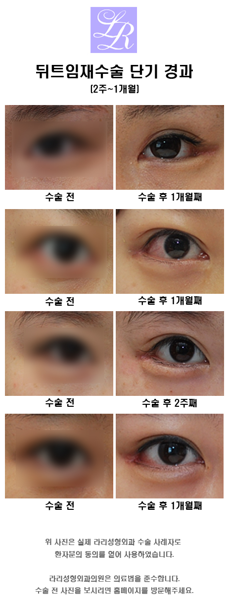 Revision Lateral Canthoplasty: Short-Term, Mid-Term, and Long-Term Progress (feat. Lari) image 3