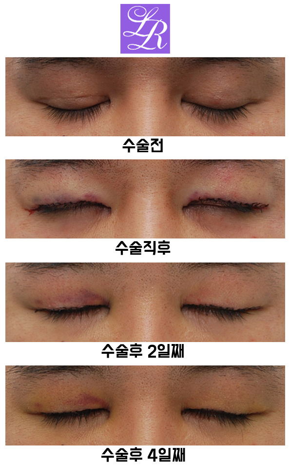 Review of Double Eyelid Reversal Surgery - Day 4 After Surgery, Swelling After Double Eyelid Surgery image 4