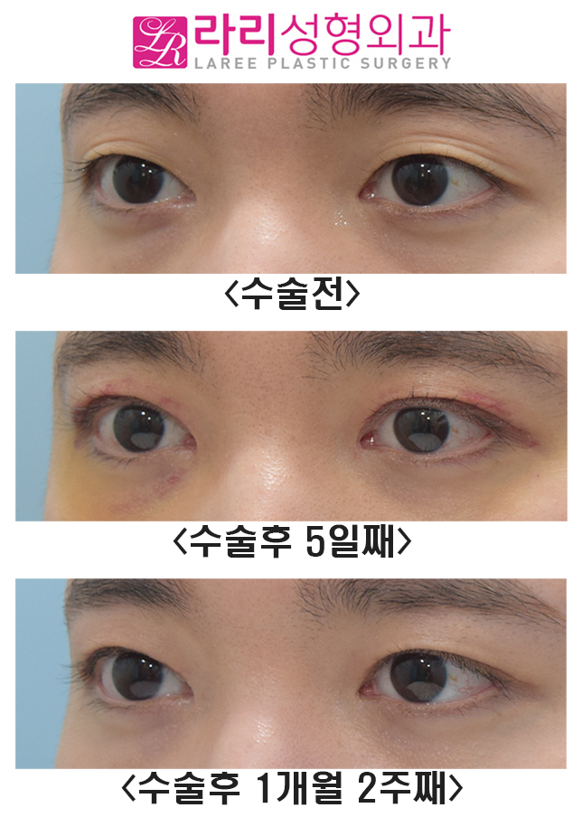[라리성형외과] 여러겹 쌍꺼풀라인 없애기 관련 이미지 6