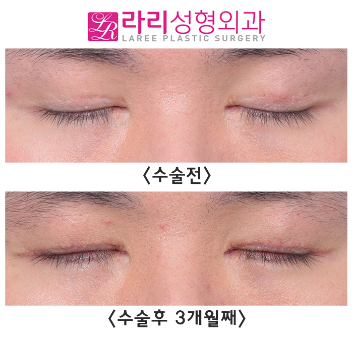 [라리성형외과] 쌍수 흉터까지 없애는 쌍꺼풀없애기수술 전후 사진 보기 관련 이미지 4