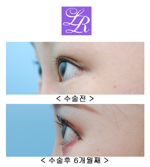 How Can You Correct Eyes With a Fierce Impression and Upturned Outer Corners? image 5