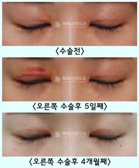 [Lari Plastic Surgery] One-sided double eyelid surgery to correct uneven eyes: Is it possible to get double eyelids on only one eye? image 7