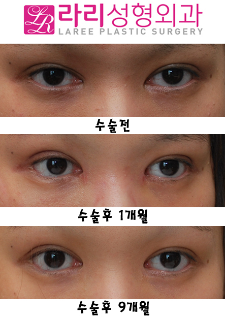 앞트임복원 후 모양변화 관련 이미지 3
