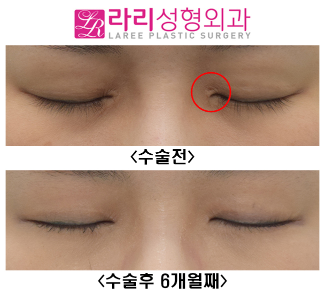 [라리성형외과]  앞트임복원수술 하지 않고 앞트임흉터 제거하는 방법 관련 이미지 5
