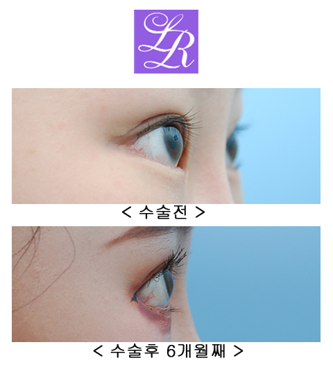 How Can You Correct Eyes With a Fierce Impression and Upturned Outer Corners? image 6