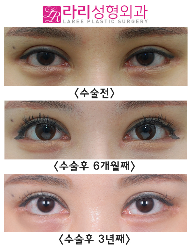 [Laree Plastic Surgery] Before-and-After Photos of Long-Term Follow-Up After Medial Epicanthoplasty Revision, Following Short-Term Follow-Up image 2