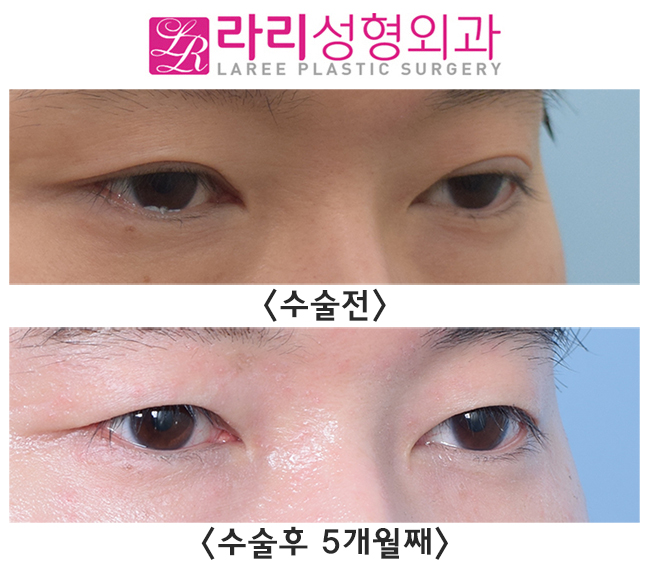 [라리성형외과] 나는 쌍꺼풀없애는수술을 하면 어떻게 될까? 관련 이미지 2