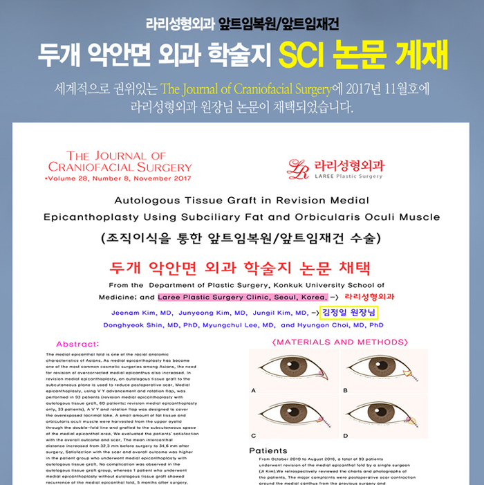 앞트임흉터제거 및 앞트임복원/앞트임재건의 효과를 알아보자! 관련 이미지 10