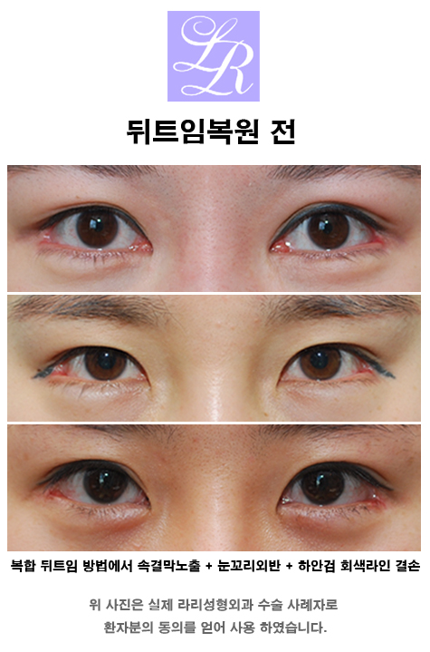 Lateral Canthoplasty Restoration - When Is the Reconstruction Timing Before and After Revision Surgery? image 7