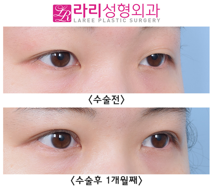 [Lari Plastic Surgery] One-sided Eye Asymmetry Incisional Double Eyelid Surgery with Ptosis Correction: Before-and-After Photos One Month After Surgery image 2