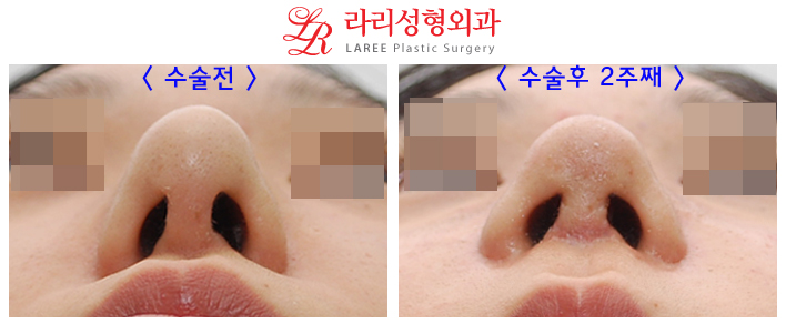 코재수술 잘하는곳 변화가 확실한 라리성형외과! 관련 이미지 4