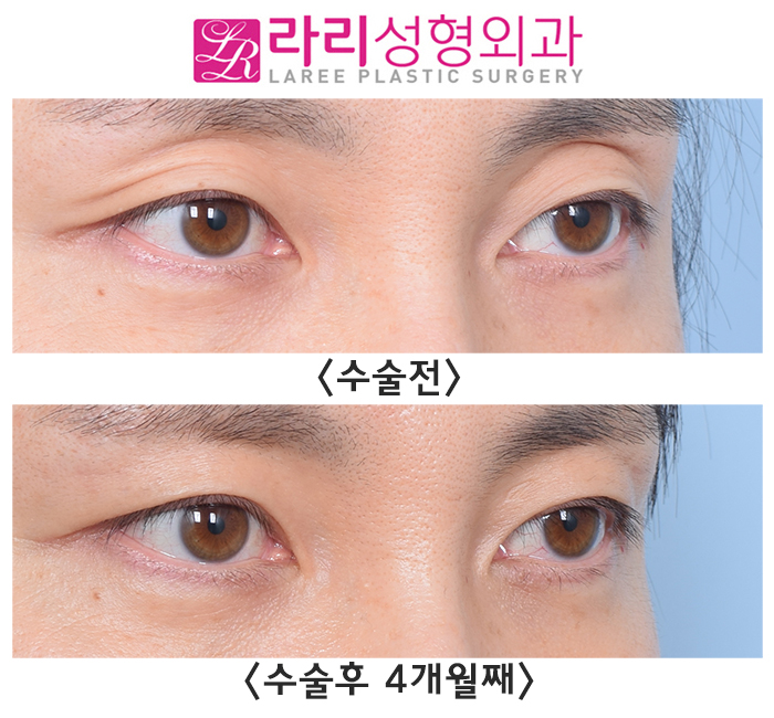 [Lari Plastic Surgery] For Improving Sunken Eyelids: Incisional Double Eyelid Surgery + Upper Eyelid Fat Grafting image 3