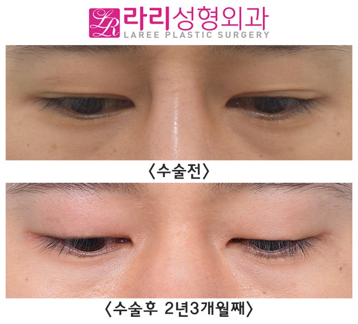 [Rari Plastic Surgery] Removing Double Eyelids Completely / No Double Eyelids When Eyes Are Open, No Double Eyelids When Eyes Are Closed image 4