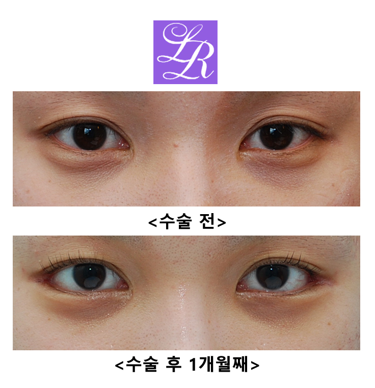 Before and After Lateral Canthoplasty (Close-up Photos - Scar at the Outer Corner Visible!) image 1