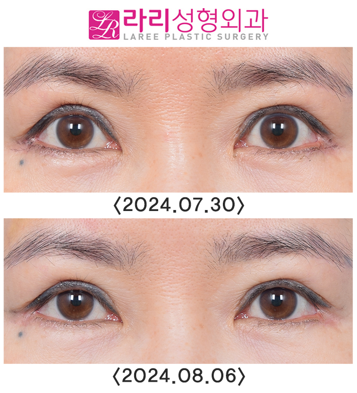 [라리성형외과] 이마보톡스가 눈 모양이나 쌍꺼풀 라인에 미치는 영향에 대하여 관련 이미지 4