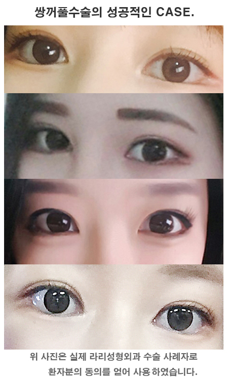 앞트임전후 많이 보면 도움이 될까 관련 이미지 6