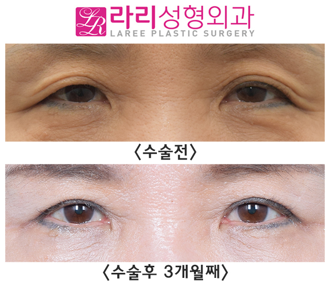 [Lari Plastic Surgery] The secret to looking 10 years younger in middle age is upper eyelid surgery! image 1