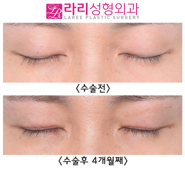 [Lari Plastic Surgery] For Improving Sunken Eyelids: Incisional Double Eyelid Surgery + Upper Eyelid Fat Grafting image 2