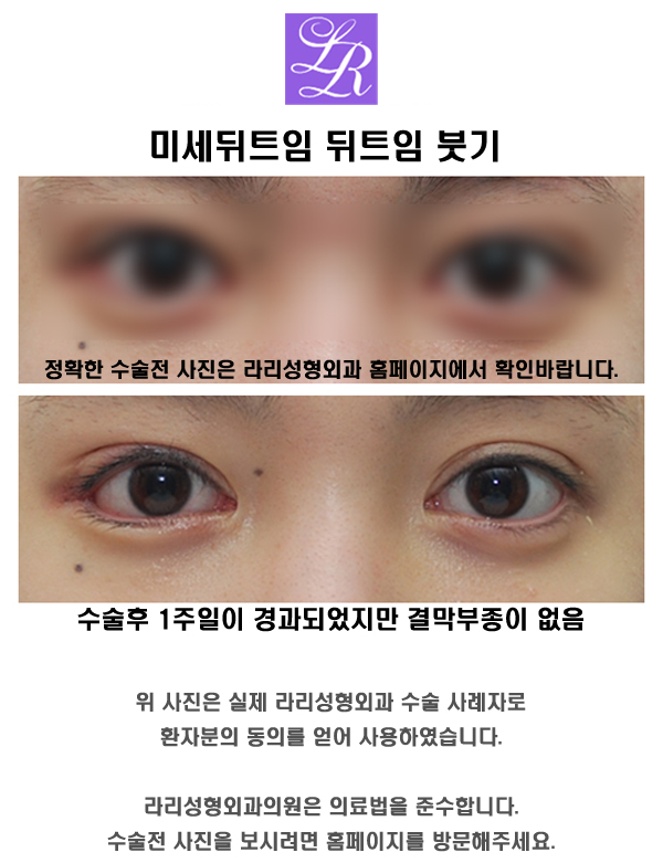 Is Swelling After Lateral Canthoplasty, Conjunctival Edema, a Side Effect? image 3