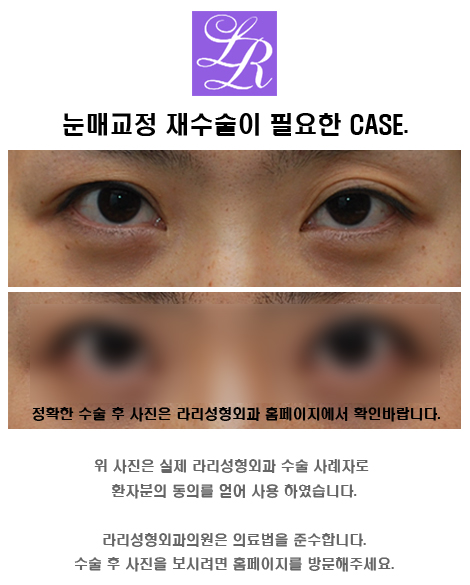 When Reoperation Is Needed for Ptosis Correction Surgery, and the Timing of Surgery (feat. Rapid Correction) image 2