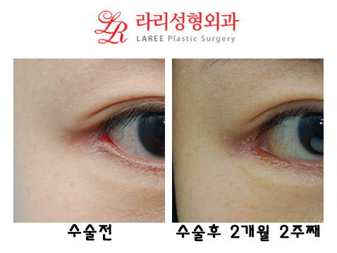 쌍꺼풀재수술(쌍꺼풀낮추는수술),뒤트임재수술,트임없는앞트임 관련 이미지 5